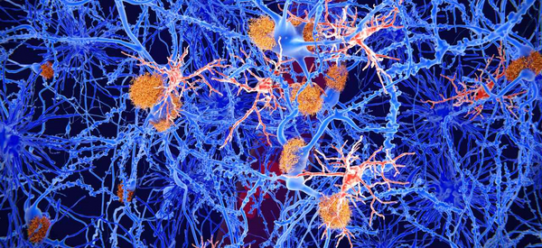 Vernetzte Hirnzellen: Mikroglia-Zellen spielen eine wichtige Rolle bei der Pathogenese der Alzheimer-Krankheit, Amyloid, Atherosklerose
