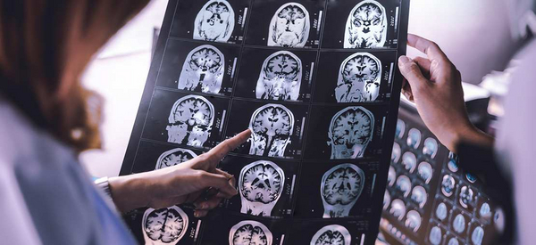 MRI-Untersuchung eines Gehirns